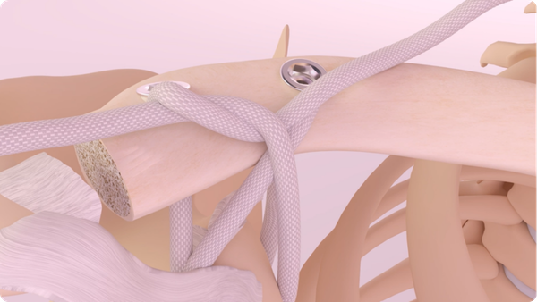 Movmedix LARS Acromioclavicular 3D